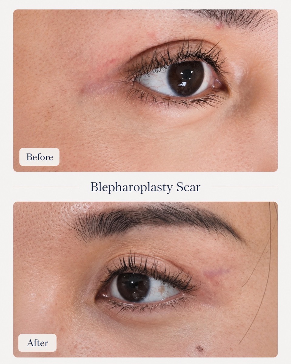 Blepharoplasty Scar