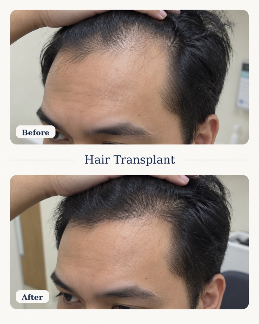 Hair transplant before and after — frontal hairline density